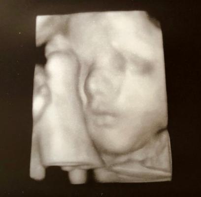 A 3D image of Lydias face, loved by parents Leah and Sean Howard.